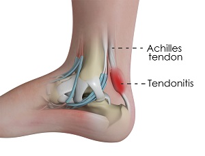 Achilles Tendinitis Treatment