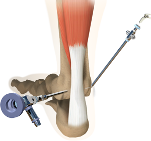 Ankle Arthroscopy