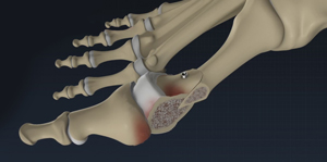 Foot and Ankle Osteotomy