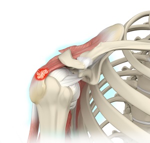 Calcification Tendinitis