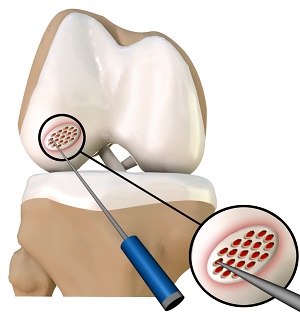 Cartilage Microfracture