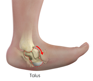 Congenital Limb Deformities