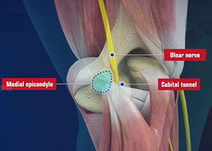 Cubital Tunnel Syndrome (Ulnar Nerve Entrapment) 01