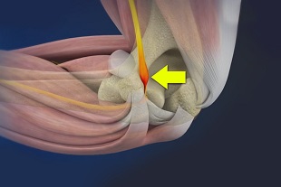 Cubital Tunnel Syndrome (Ulnar Nerve Entrapment) 02