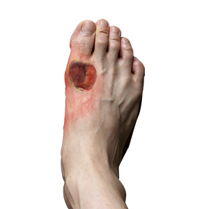 Diabetic Foot Conditions