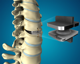 Disc Arthroplasty