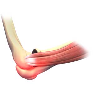 Elbow Sprain