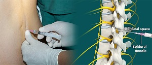 Epidural Spinal Injection