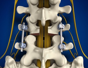 Fracture Stabilisation