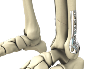 Open Reduction and Internal Fixation of the Ankle