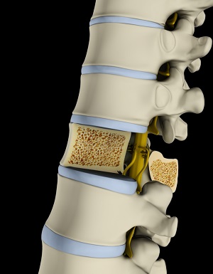 Osteoporosis of the Spine