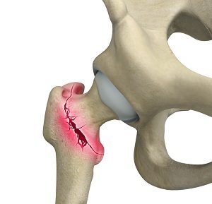 Osteoporotic Fractures