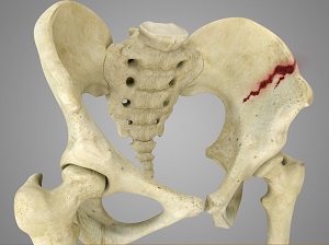 Pelvic Fractures