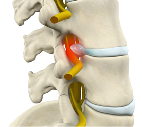 Radiculopathy