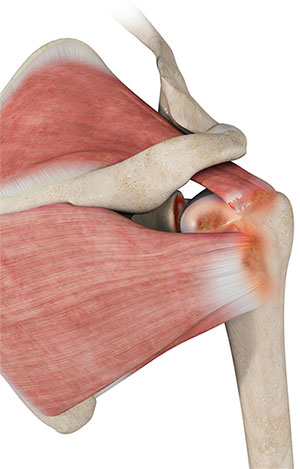 Rotator Cuff Arthropathy