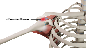 Shoulder Bursitis