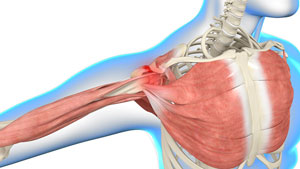 Shoulder Impingement