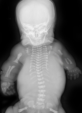 hypochondroplasia symptoms