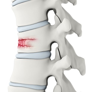 Spinal Fractures