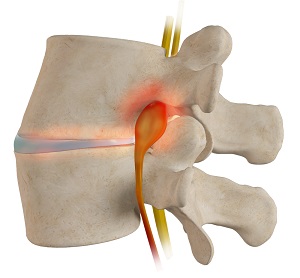 Spinal Stenosis