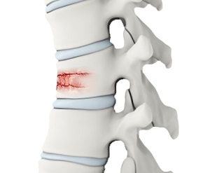 Spine Trauma