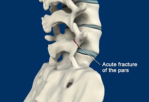 Spondylolisthesis