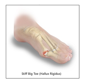 Stiff Big Toe (Hallux Rigidus)