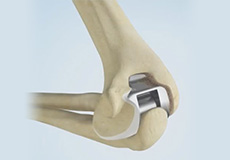 Total Elbow Replacement