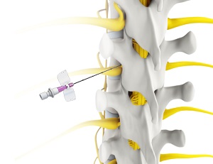 Transforaminal Epidural Steroid Injection