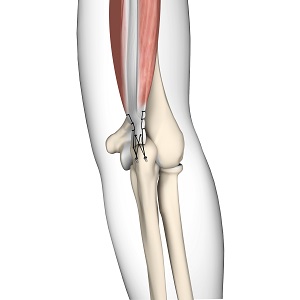 Triceps Repair