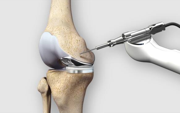 Robotic Knee & Hip Replacement